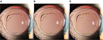 Posterior Capsular Outcomes of Pediatric Cataract Surgery With In-The-Bag Intraocular Lens Implantation